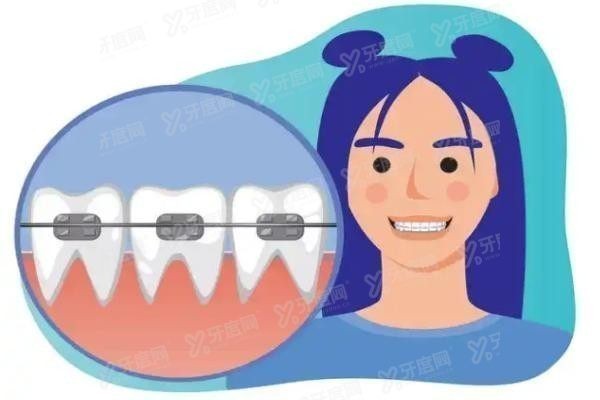 时代天使隐形牙套价格