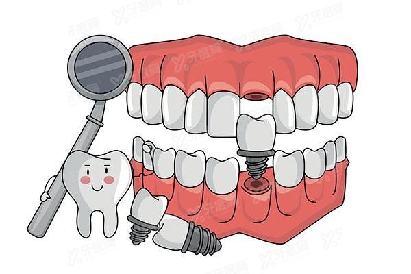 种植牙齿什么品牌比较好用www.yadoo.cn20250407104650.jpg