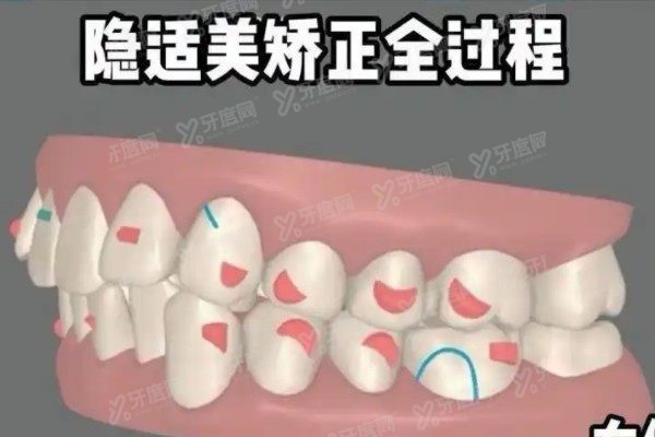 隐适美矫正<span style=