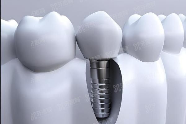 洛阳济仁口腔种植牙多少钱www.yadoo.cn