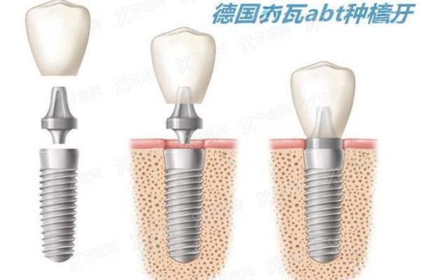德国卡瓦ABT种植体怎么样www.yadoo.cn
