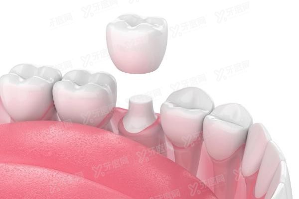 进口全瓷牙冠有哪些品牌比较好www.yadoo.cn20250508415962.jpg