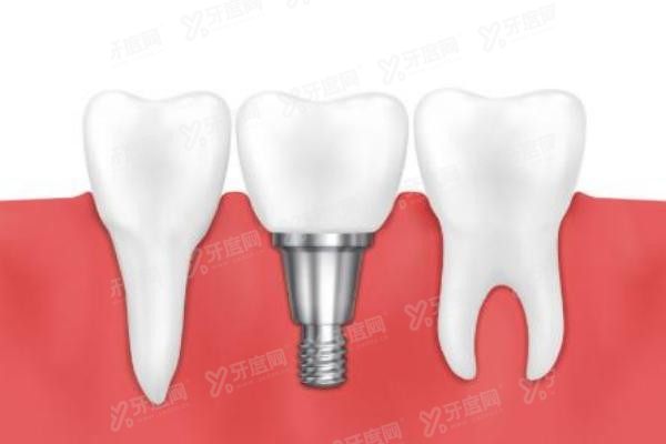 深圳童美口腔医院种植牙技术如何www.yadoo.cn20250513472109.jpg