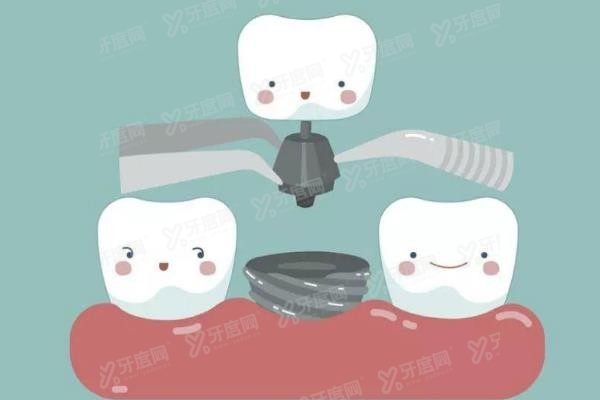 德国卡瓦abt和韩国奥齿泰哪个好www.yadoo.cn