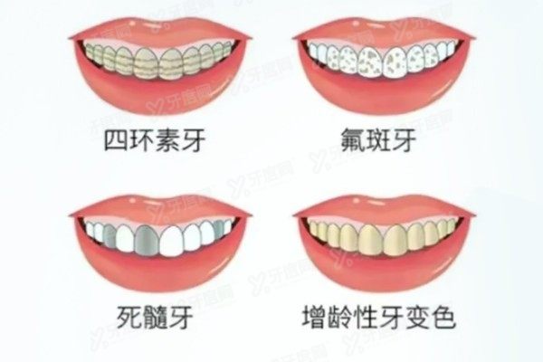 做16颗瓷贴面多少钱www.yadoo.cn