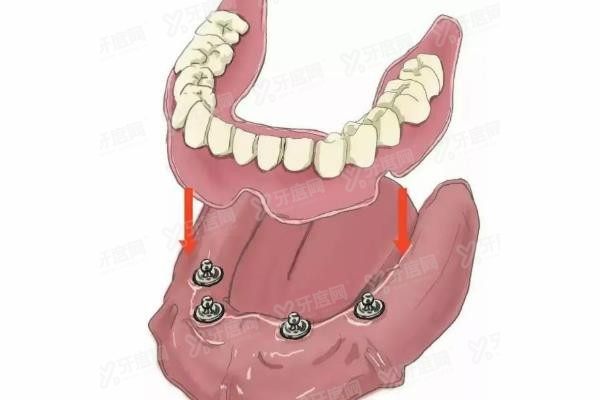 全口即刻负重病例展示www.yadoo.cn