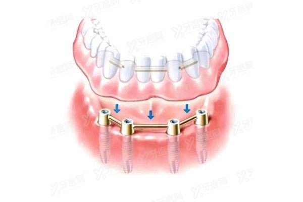 全口即刻负重病例展示www.yadoo.cn