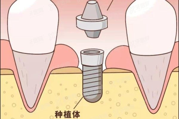 高端种植体有哪些品牌www.yadoo.cn