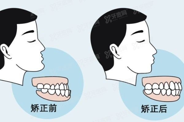 地包天牙性和骨性区别www.yadoo.cn