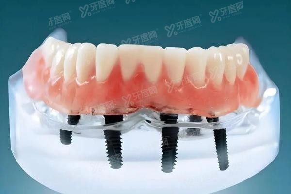 拜尔口腔医院种植牙怎么样www.yadoo.cn20250606783376.jpg