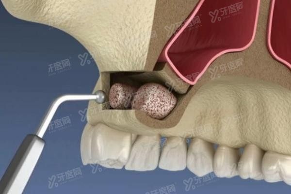 0岁老人种牙价格表