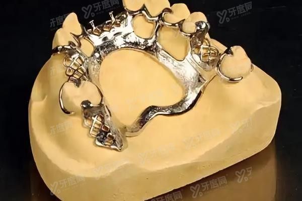 维他灵和纯钛支架哪个好