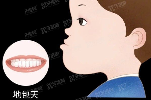 重庆地包天矫正需要多少费用