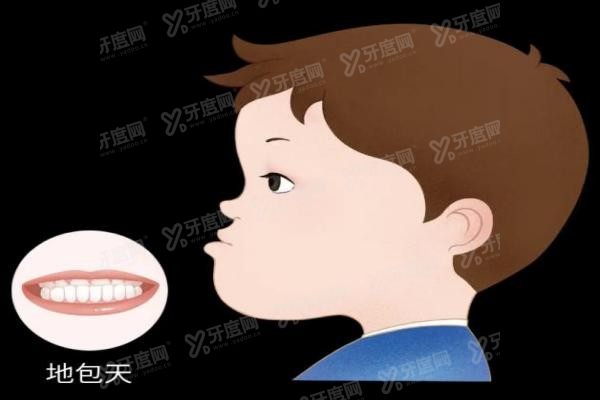 反颌矫正器哪种比较好