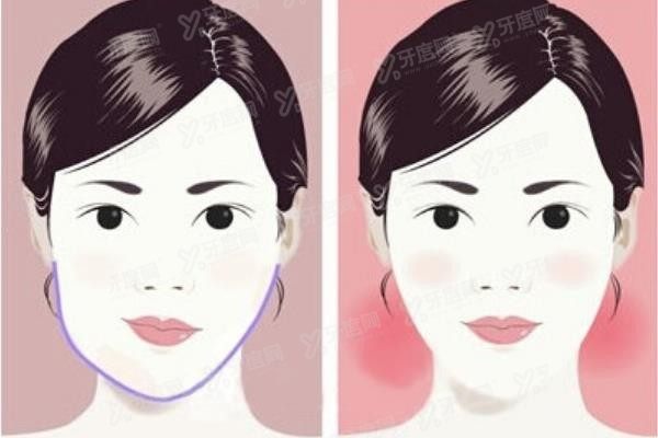 何锦泉正颌手术亲历者