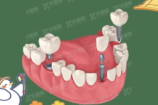 集采进口种植牙价格表
