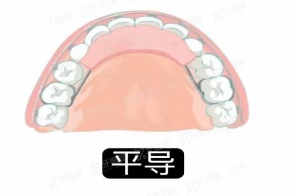 深覆合平导和颌垫佩戴时间