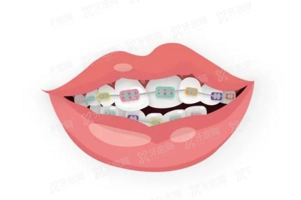福州登特口腔医院矫正活动是真的吗