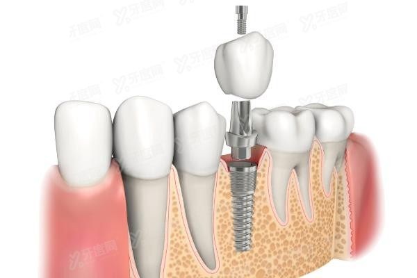 登腾和诺贝尔种植体哪个好www.yadoo.cn20250422450608.jpg 登腾和诺贝尔种植体哪个好www.yadoo.cn20250422450608.jpg