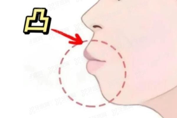 牙性和骨性嘴凸对比