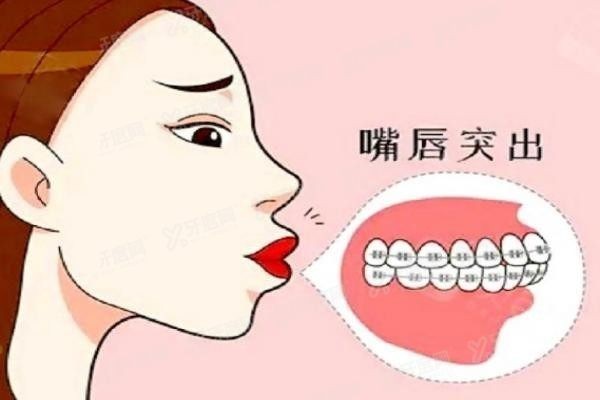 骨性凸嘴和牙性凸嘴哪个矫正费用低