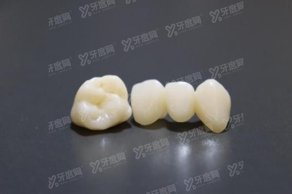 做牙冠一般建议选什么样的材料