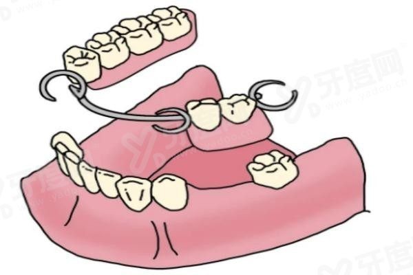 吸附义齿是什么材料做的