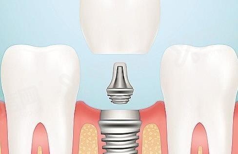 20251106524914.jpg 种植牙3.jpg