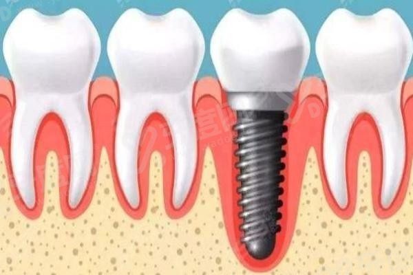 20251106423380.jpg 种植牙4(1).jpg