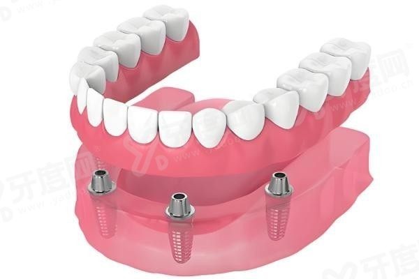 20251107383712.jpg 种植牙2.jpg