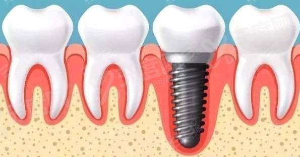 种植牙4.jpg