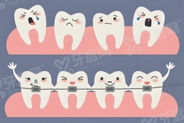 维他灵支架和纯钛支架区别