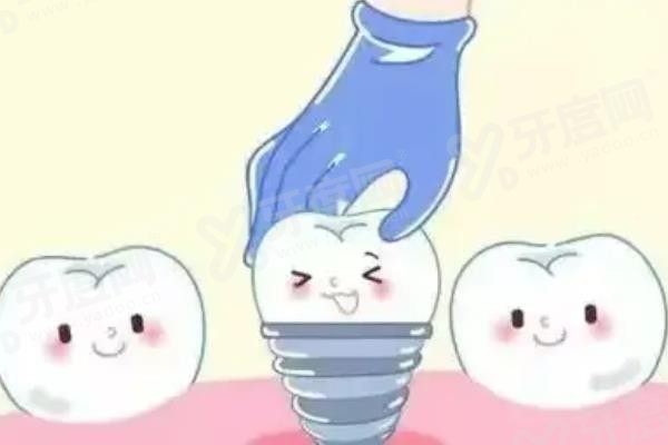 无锡佳士洁口腔种植牙价格