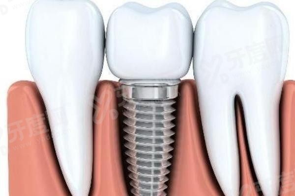 20251113281765.jpg 种植牙7(1).jpg