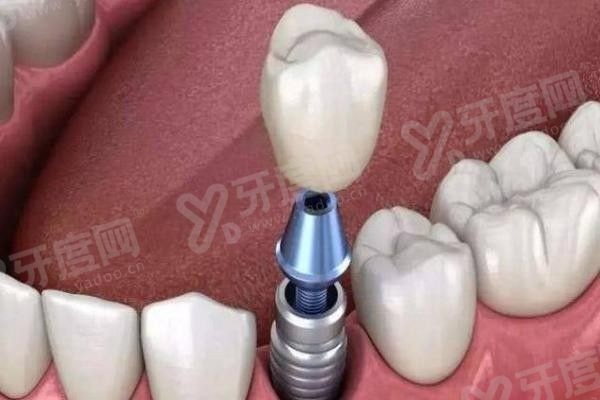 20251113293761.jpg 种植牙5(1).jpg