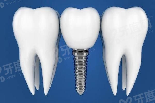20251117786631.jpg 种植牙8(1).jpg