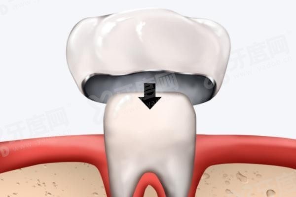 20251118871996.jpg 牙冠.jpg