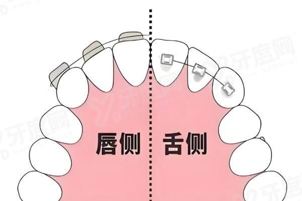 20251120577500.jpg 舌侧正畸.jpg