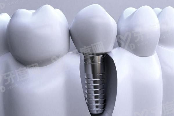 20251124785143.jpg 种植牙9(1).jpg