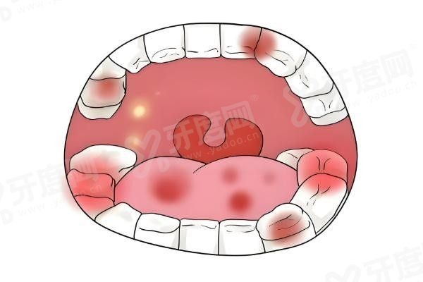 重庆根管治疗多少钱一颗牙