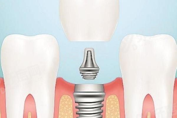 20251202944268.jpg 种植牙3(1).jpg