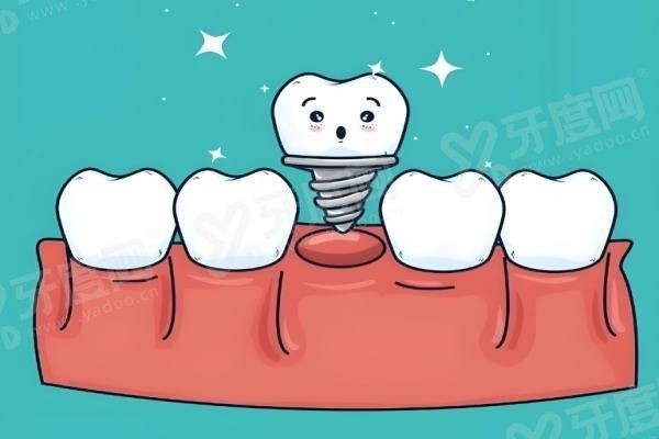 20251204873020.jpg 种植牙.jpg