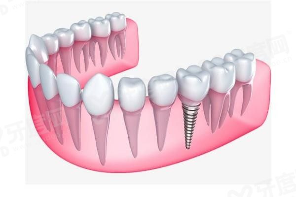 20251208904659.jpg 种植牙(1).jpg