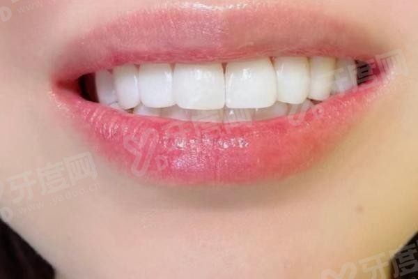20251208806995.jpg 牙齿美白.jpg