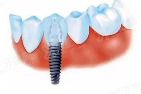 20251210200934.jpg 种植牙6(1).jpg