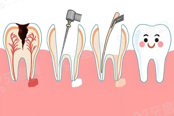 20251212181128.jpg 根管治疗.jpg