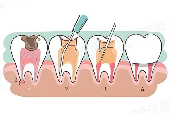 20251216389614.jpg 根管治疗2.jpg