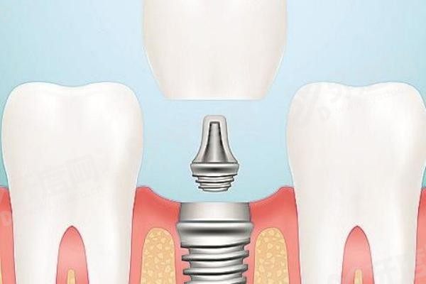 20251218335920.jpg 种植牙3(1).jpg