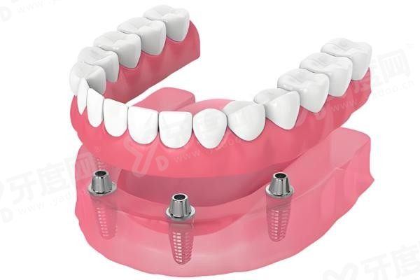 20251225273438.jpg 种植牙2.jpg