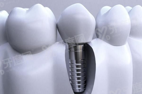种植牙9(1).jpg